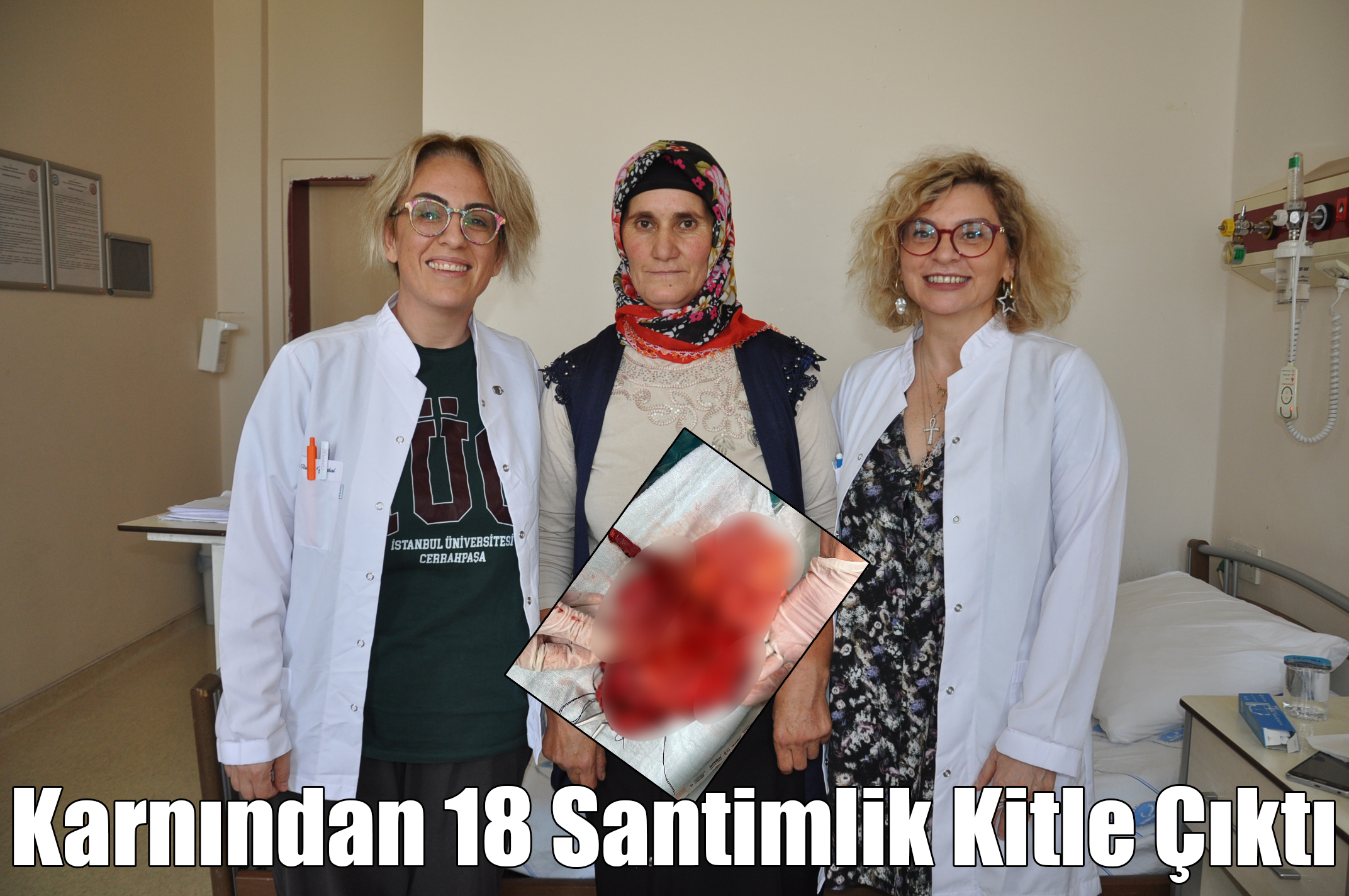 Karnından 18 Santimlik Kitle Çıktı